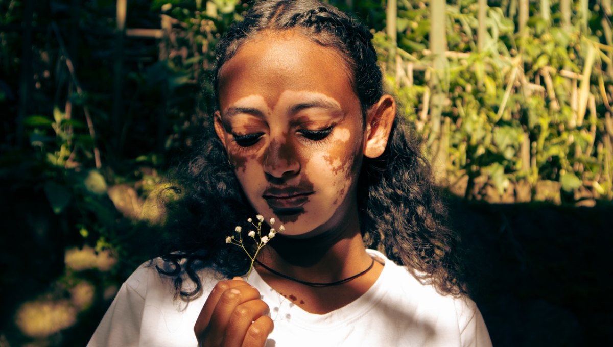 Cómo maquillar el vitiligo en la cara